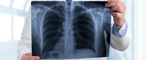 What Are the Early Signs of Pneumonia?