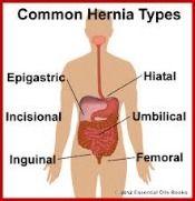 Do I Have a Hernia?