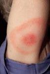 What Steps to To Take if Bitten By a Deer Tick