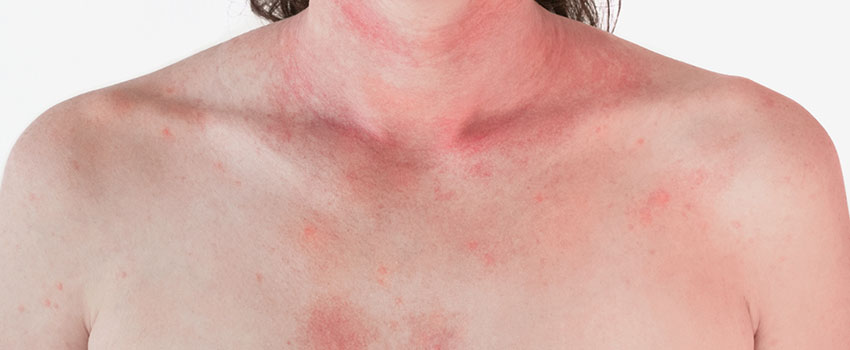 How to Treat Rashes at Home