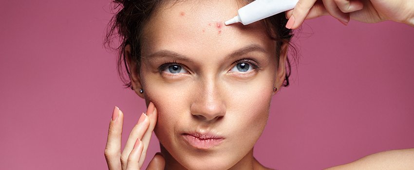 What Are My Options When It Comes to Treating Acne?