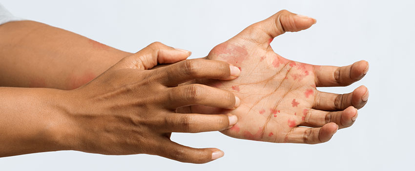 Is It Possible to Get Rid of Eczema?