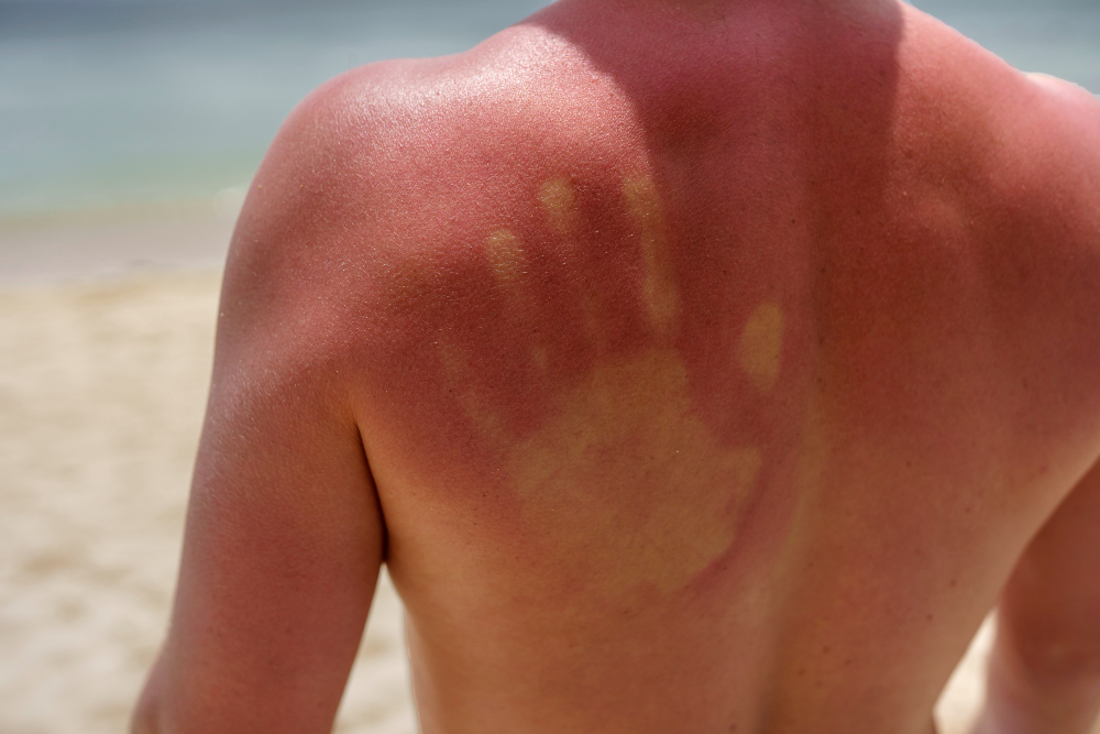 What Are the Degrees of Burns? A Guide to Identifying Burns
