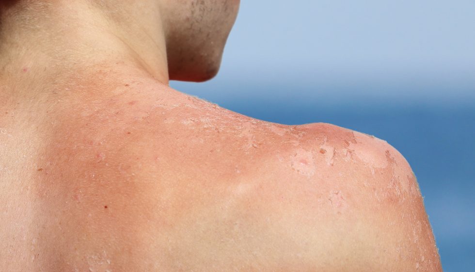 How Long Does Sun Poisoning Last?