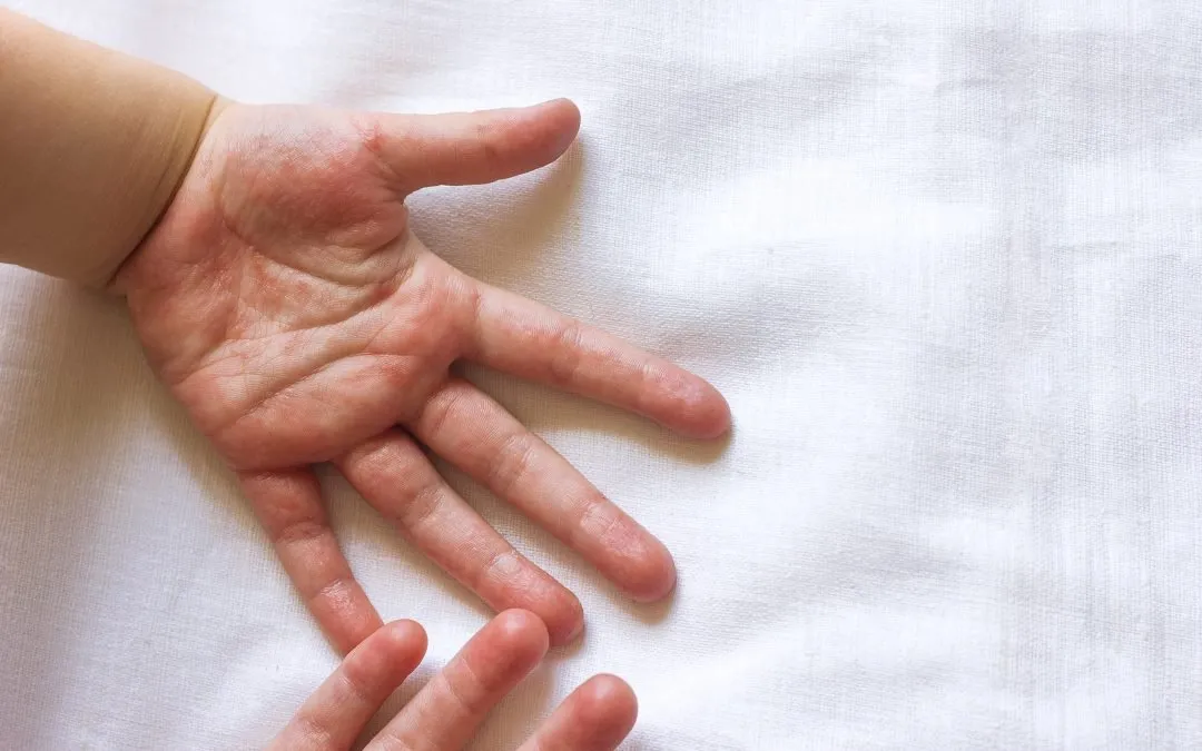 A child showing their hands with a rash from hands, foot, and mouth disease