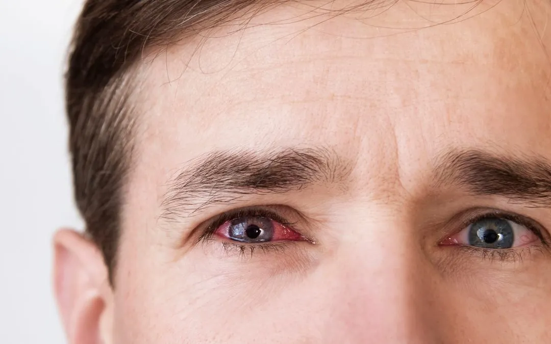 Close up of male eyes with a reddened infection in the right eye